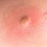 Abscess/Boils